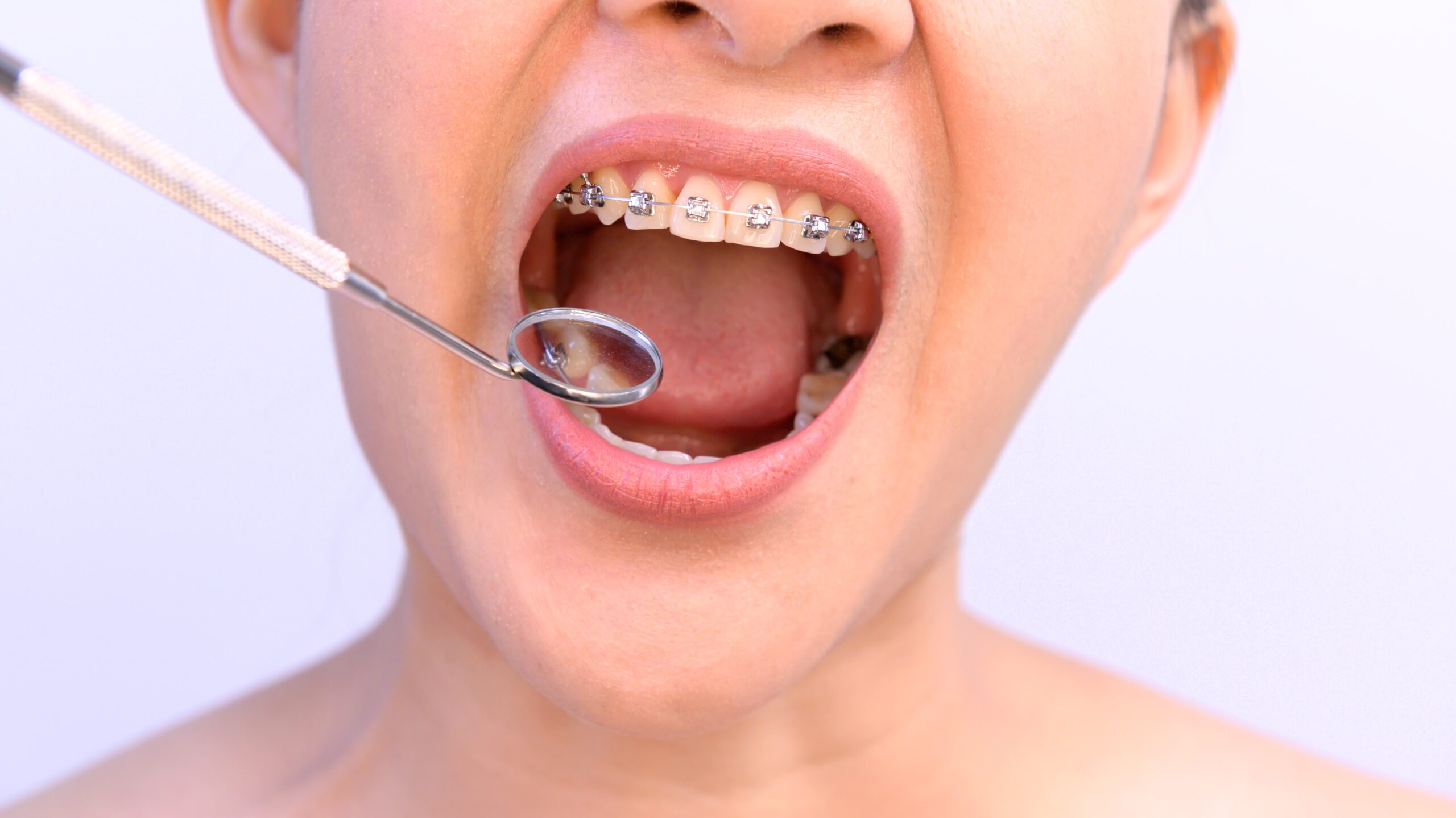 Common Smile Imperfections After Braces