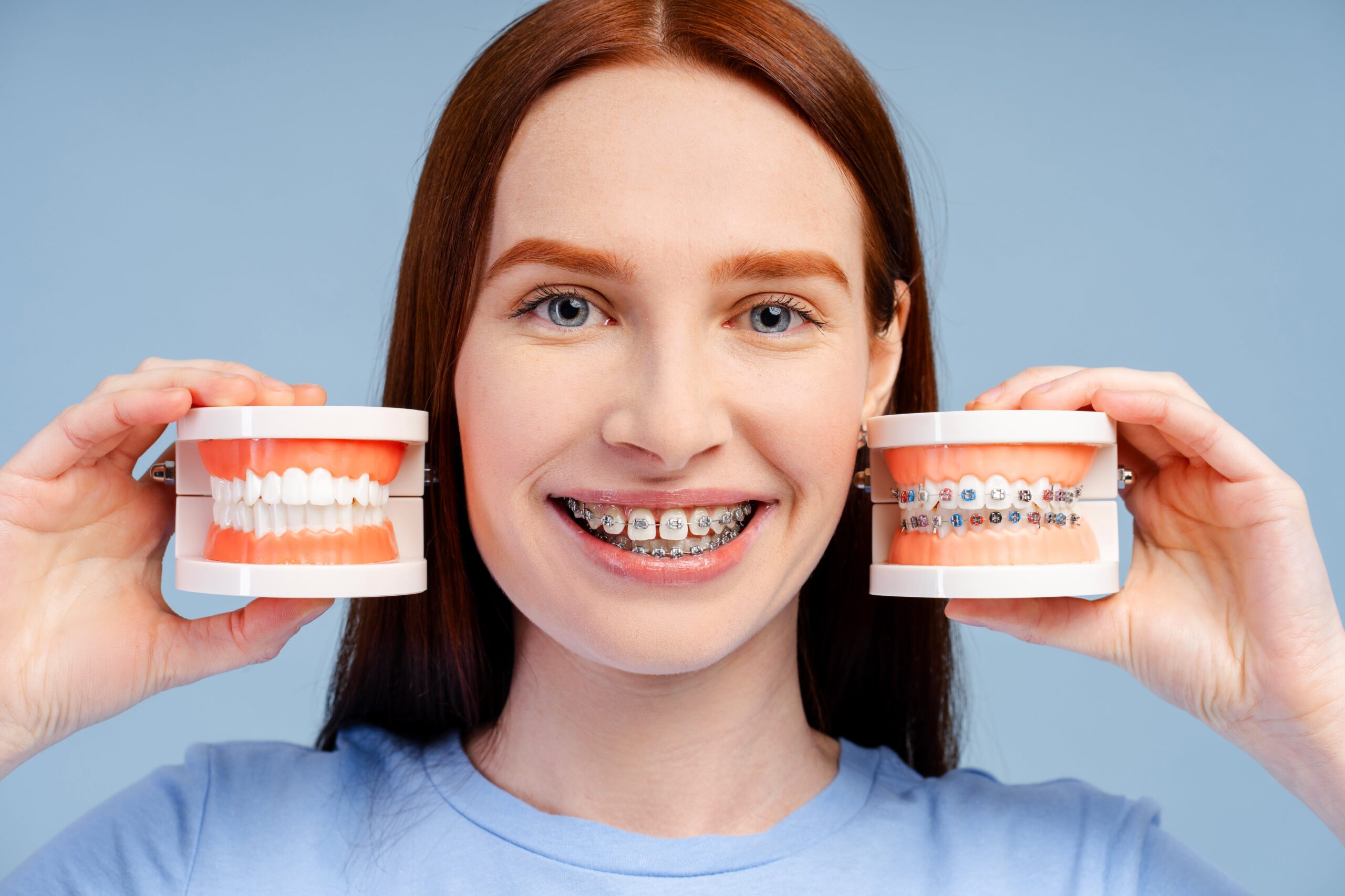 Should You Consider Veneers After Orthodontic Treatment?