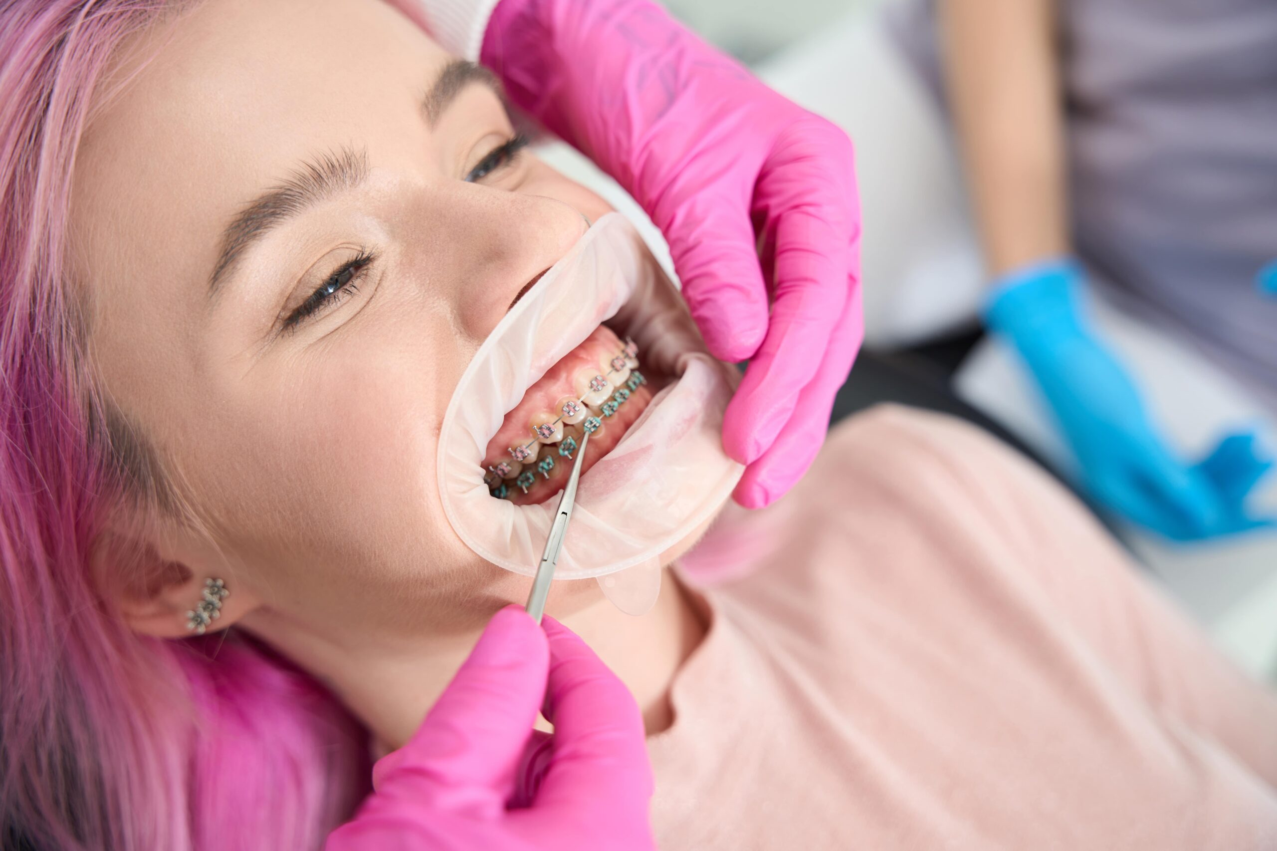 Gum Reshaping After Braces