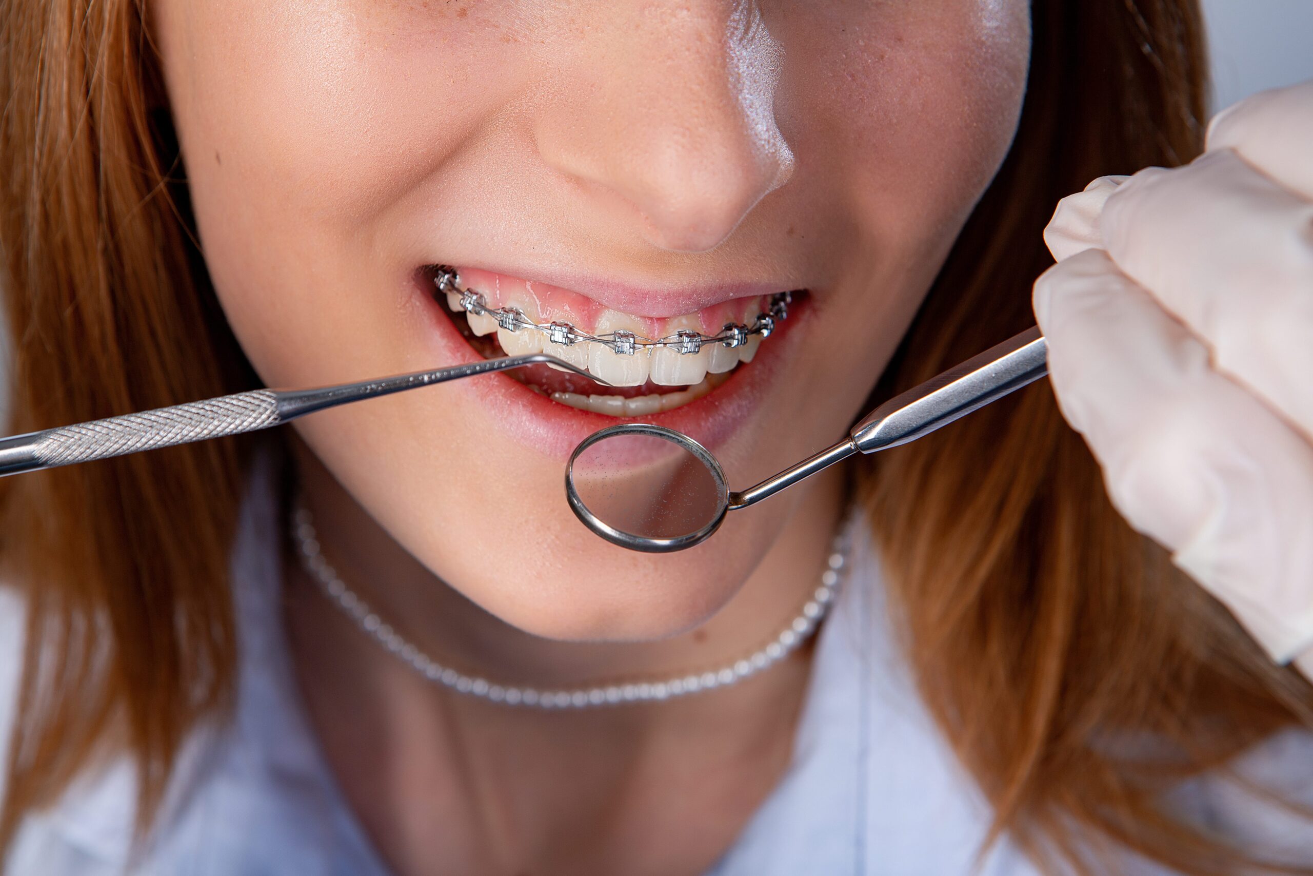 Sensitive Teeth After Braces