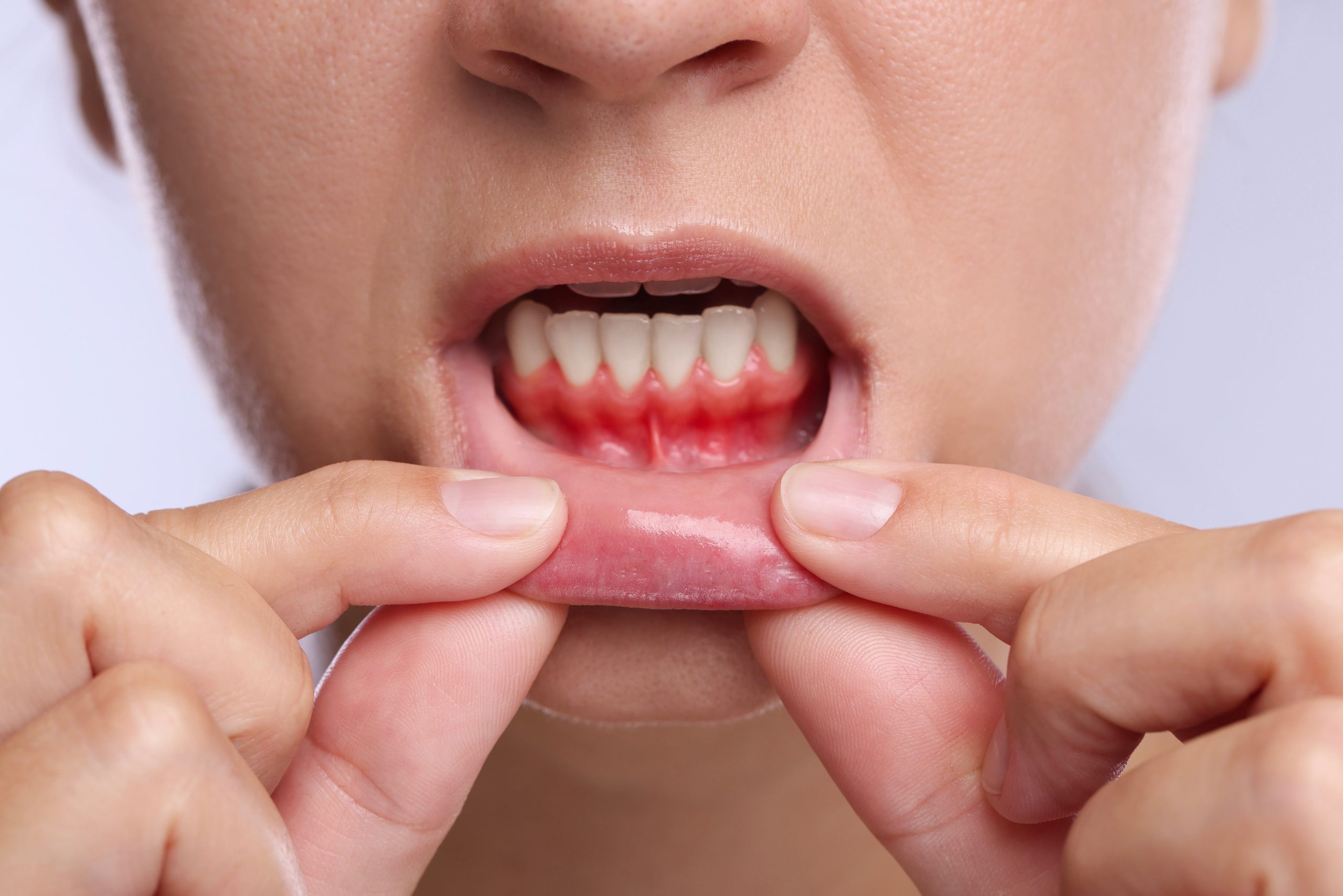 How to Cure Gum Disease Without a Dentist